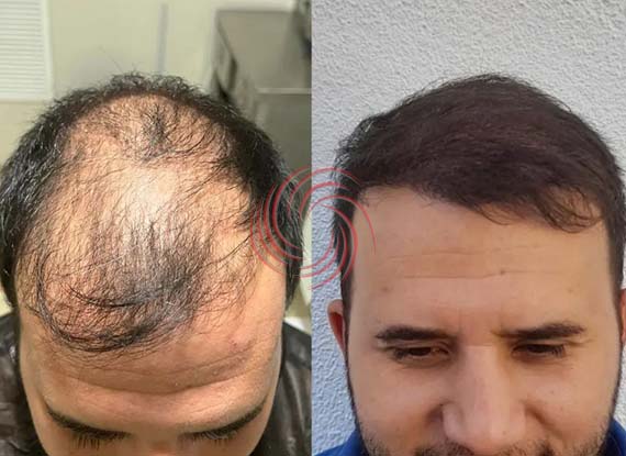 3600 Greft Saç Ekimi Öncesi Sonrası