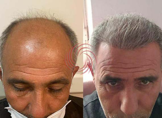 saç ekim öncesi sonrası 7