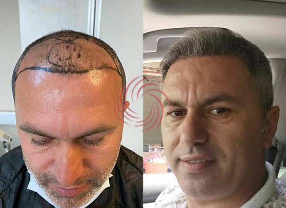 saç ekim öncesi sonrası 8